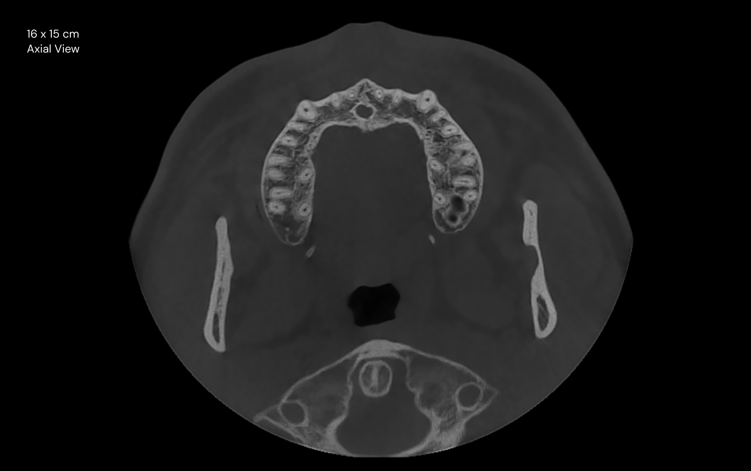 16 x 15 cm Axial View
